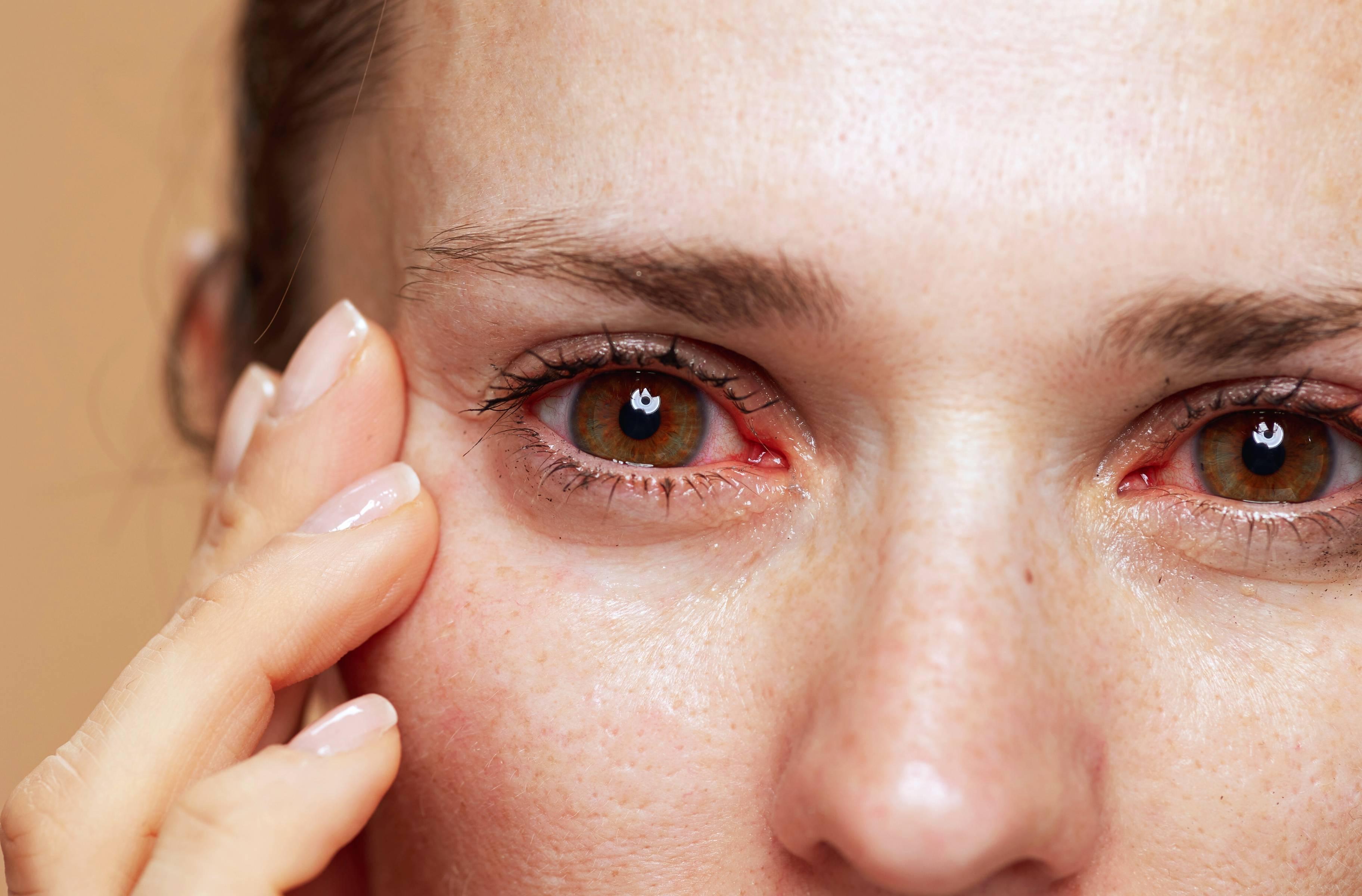 Allergies oculaires et conjonctivite: comment les diffrencier? Iris Allergies oculaires et conjonctivite: comment les diffrencier? Iris