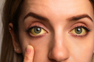 Yeux jaunes : Causes et traitements