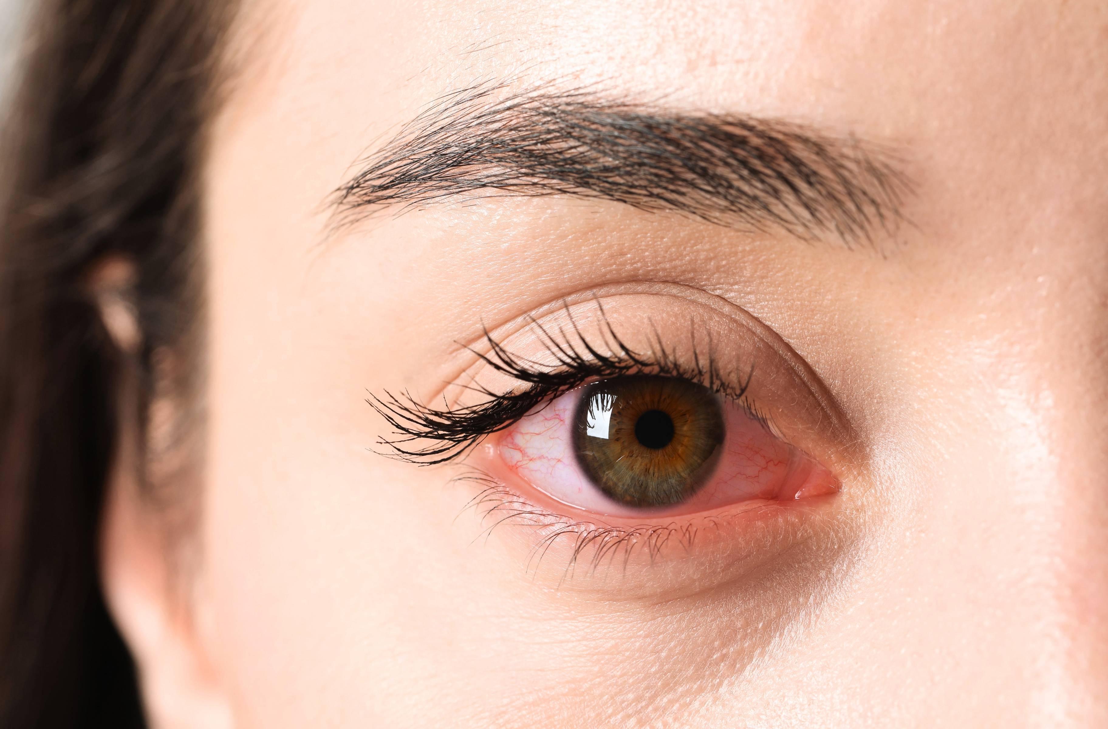 Causes symptômes et traitements pour les yeux rouges – Iris